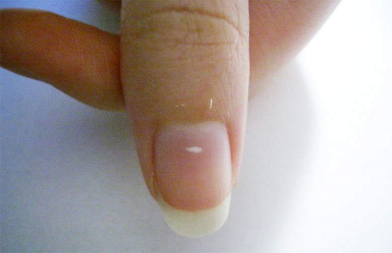 Заусенцы на пальцах – почему появляются и как от них избавиться